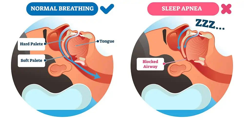 sleep apnea Diagram