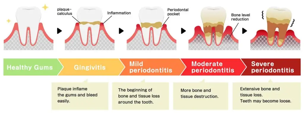 stages of periodontal disease